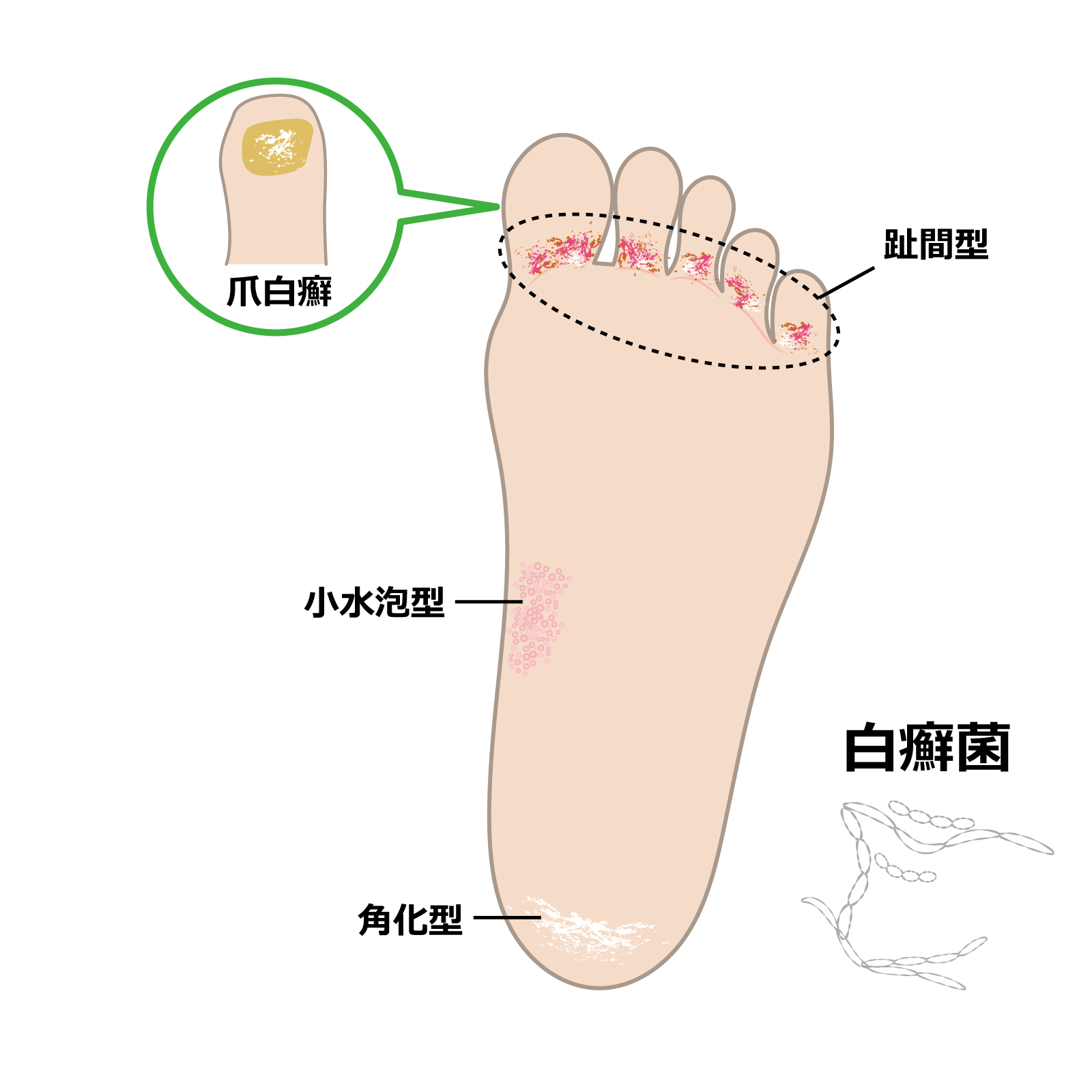 白癬（水虫・爪白癬